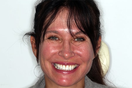 Before and After Invisalign Treatment Milton Keynes