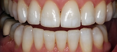 Before and After Invisalign Treatment Milton Keynes