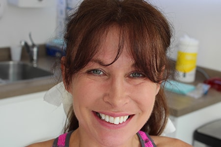 Before and After Invisalign Treatment Milton Keynes