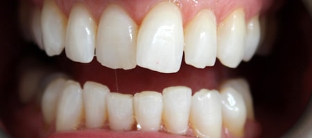 Before and After Invisalign Treatment Milton Keynes