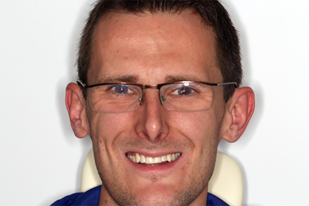 Before and After Invisalign Treatment Milton Keynes