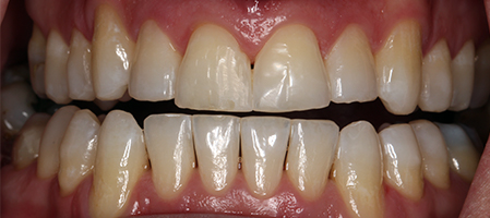 Before and After Invisalign Treatment Milton Keynes