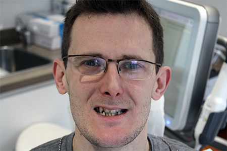 Before and After Invisalign Treatment Milton Keynes