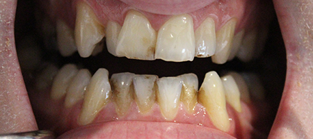 Before and After Invisalign Treatment Milton Keynes