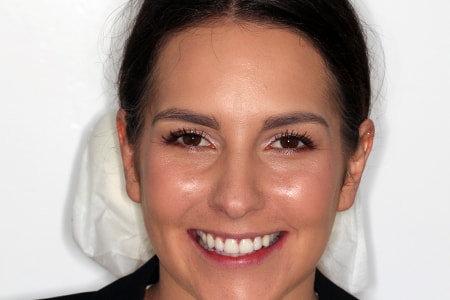 Before and After Invisalign Treatment Milton Keynes