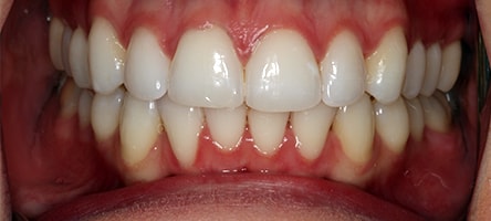Before and After Invisalign Treatment Milton Keynes