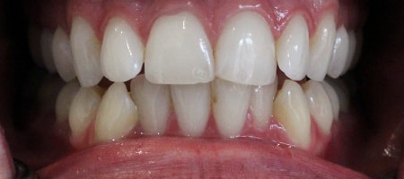 Before and After Invisalign Treatment Milton Keynes