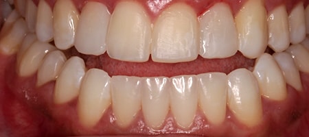 Before and After Invisalign Treatment Milton Keynes