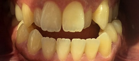 Before and After Invisalign Treatment Milton Keynes