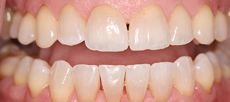 Before and After Invisalign Treatment Milton Keynes