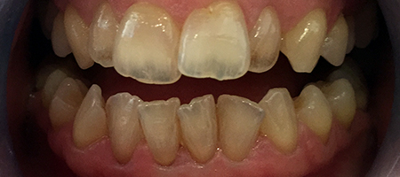 Before and After Invisalign Treatment Milton Keynes
