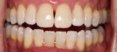 Before and After Invisalign Treatment Milton Keynes
