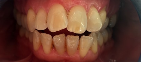 Before and After Invisalign Treatment Milton Keynes