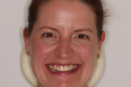 Before and After Invisalign Treatment Milton Keynes