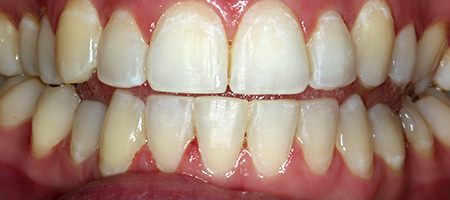 Before and After Invisalign Treatment Milton Keynes