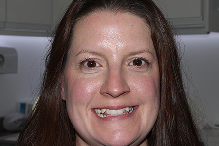 Before and After Invisalign Treatment Milton Keynes