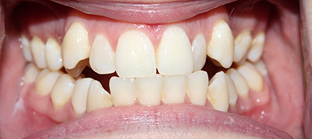 Before and After Invisalign Treatment Milton Keynes