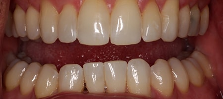 Before and After Invisalign Treatment Milton Keynes