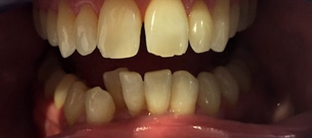 Before and After Invisalign Treatment Milton Keynes