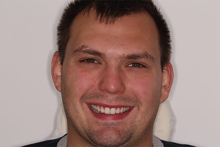 Before and After Invisalign Treatment Milton Keynes