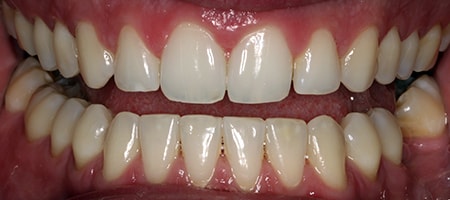 Before and After Invisalign Treatment Milton Keynes