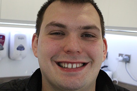 Before and After Invisalign Treatment Milton Keynes