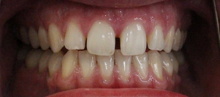 Before and After Invisalign Treatment Milton Keynes