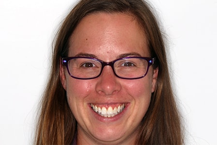 Before and After Invisalign Treatment Milton Keynes