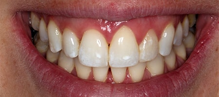 Before and After Invisalign Treatment Milton Keynes