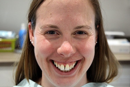 Before and After Invisalign Treatment Milton Keynes
