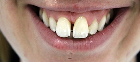 Before and After Invisalign Treatment Milton Keynes