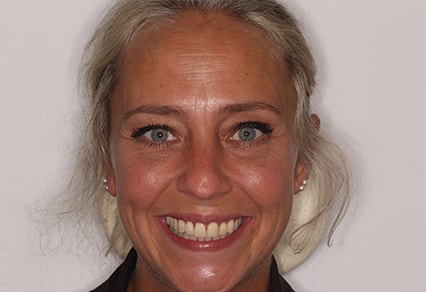 Before and After Invisalign Treatment Milton Keynes