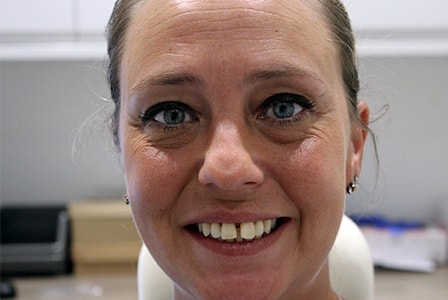 Before and After Invisalign Treatment Milton Keynes