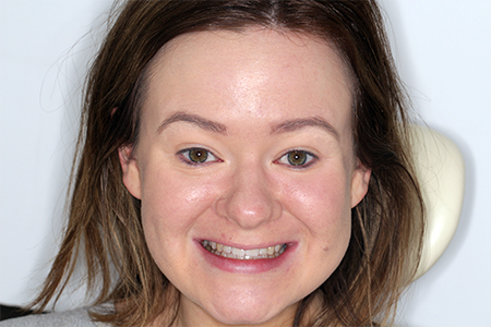 Before and After Invisalign Treatment Milton Keynes