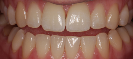 Before and After Invisalign Treatment Milton Keynes