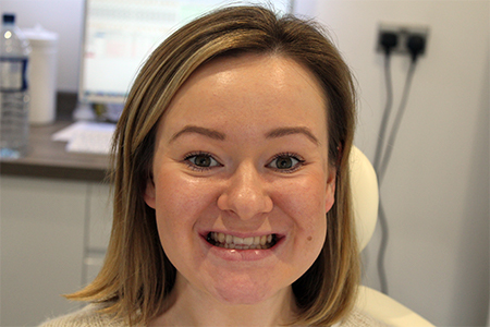 Before and After Invisalign Treatment Milton Keynes