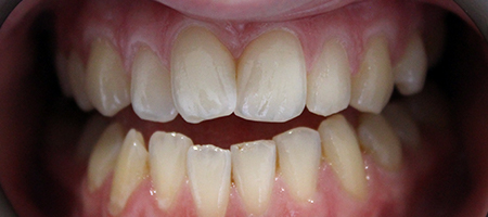 Before and After Invisalign Treatment Milton Keynes