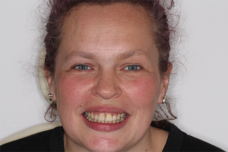 Before and After Invisalign Treatment Milton Keynes