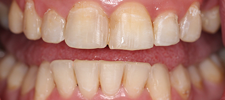 Before and After Invisalign Treatment Milton Keynes