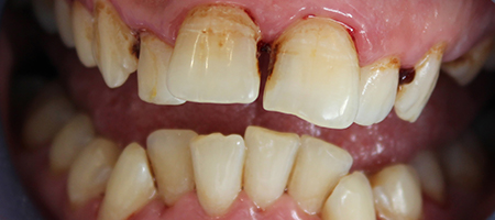 Before and After Invisalign Treatment Milton Keynes