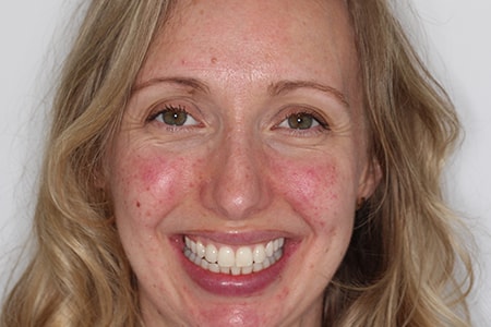 Before and After Invisalign Treatment Milton Keynes