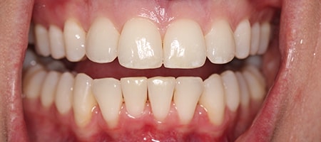 Before and After Invisalign Treatment Milton Keynes