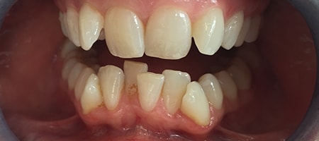 Before and After Invisalign Treatment Milton Keynes