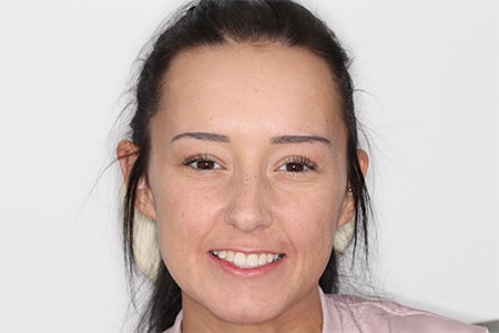 Before and After Invisalign Treatment Milton Keynes