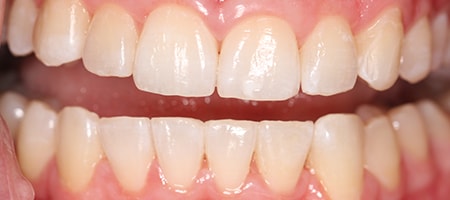 Before and After Invisalign Treatment Milton Keynes