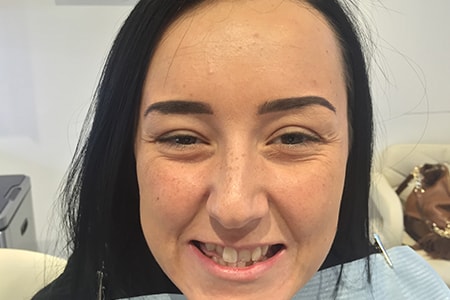 Before and After Invisalign Treatment Milton Keynes