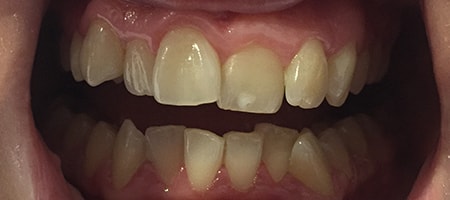 Before and After Invisalign Treatment Milton Keynes