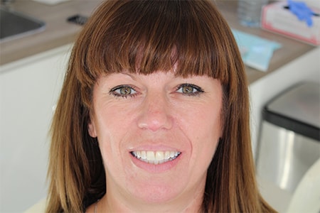 Before and After Invisalign Treatment Milton Keynes