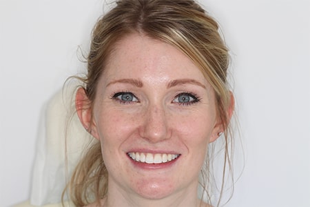 Before and After Invisalign Treatment Milton Keynes