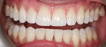 Before and After Invisalign Treatment Milton Keynes
